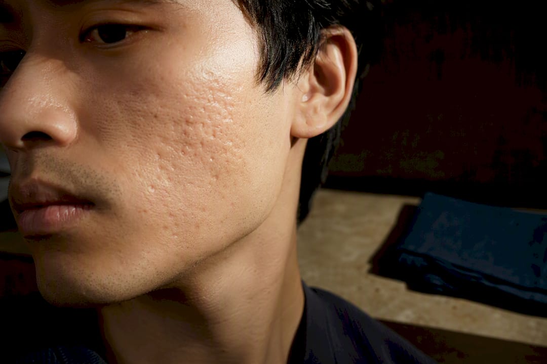Close portrait showing post-acne scar texture
